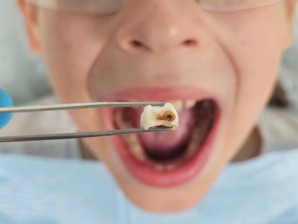 Best Emergency Treatment for Toothache in Anniston, AL